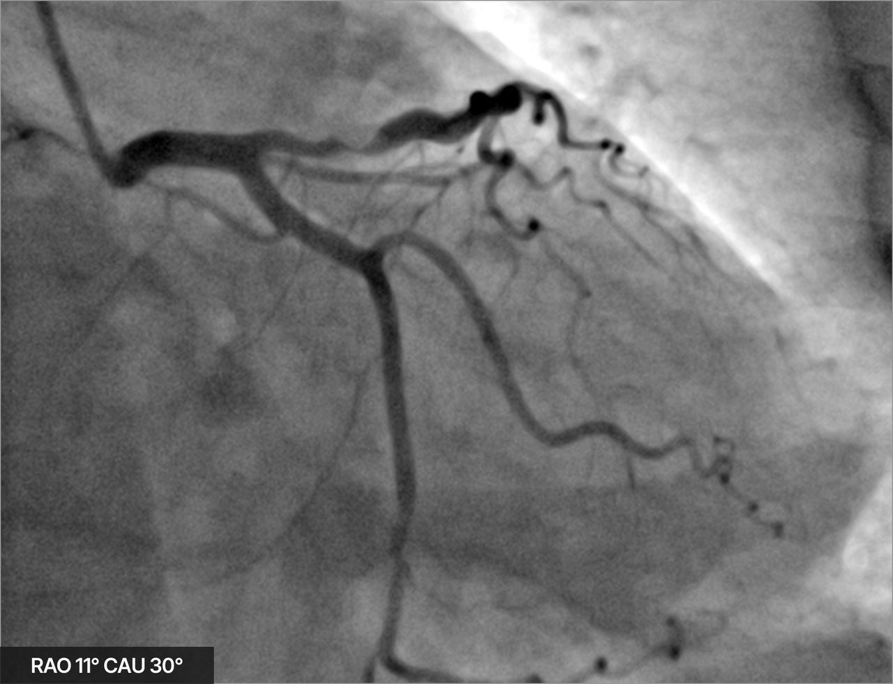 One raw angiogram frame of the left coronary arteries, nothing marked