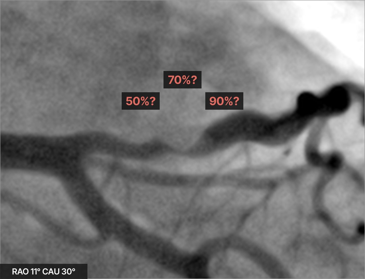 One narrowing on an angiogram with three different readings: 50, 70 or 90 percent