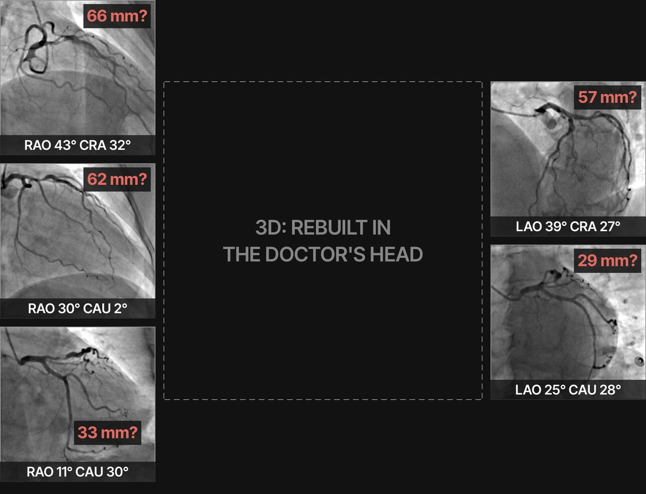 Five camera angles of the same arteries around an empty square: the 3D exists only in the doctor's head