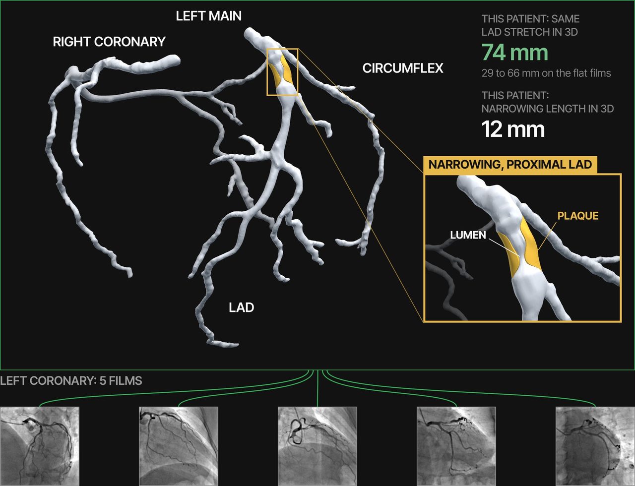 The coronary arteries as one 3D twin built from the flat films, with the narrowing enlarged